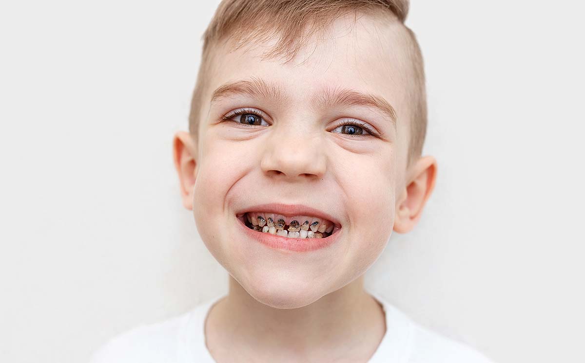 childhood caries