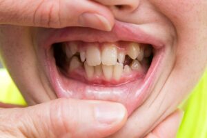 Crooked Teeth in Children