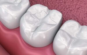Dental Sealant