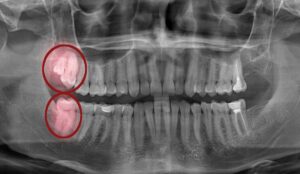 teens wisdom teeth removal