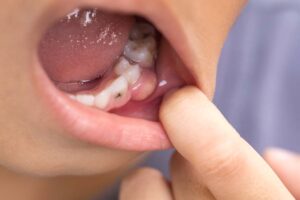 Children Cavity