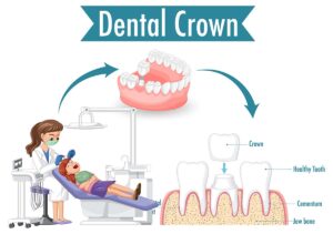 kids dental crown