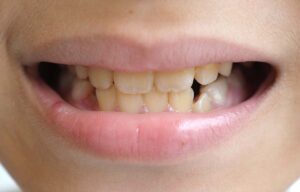 Yellow Teeth
