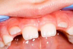 tooth irruption