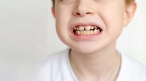 Child with Cavity