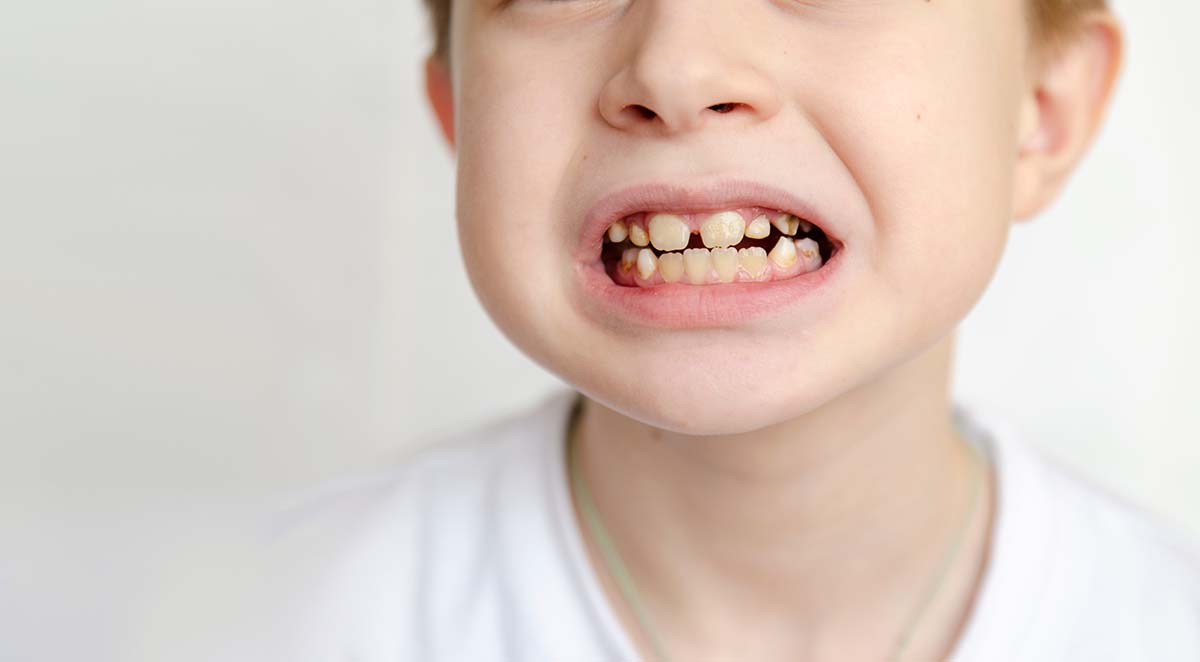 Child with Cavity