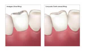 Tooth Colored Filligs