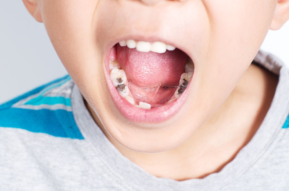 Caries and cavities in kids